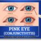 what is commonly misdiagnosed as pink eye